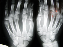 L'osteoporosi puja un 54% al veí del sud