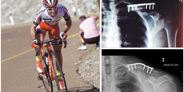 A l’esquerra, Vicioso, al Dubai Tour després de la seva lesió arran de la caiguda del Giro d’Itàlia, i la dreta, les radiografies amb la placa a la clavícula.