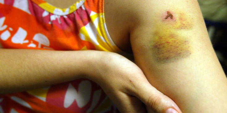 Una dona mostra les ferides i els cops que presenta al braç.