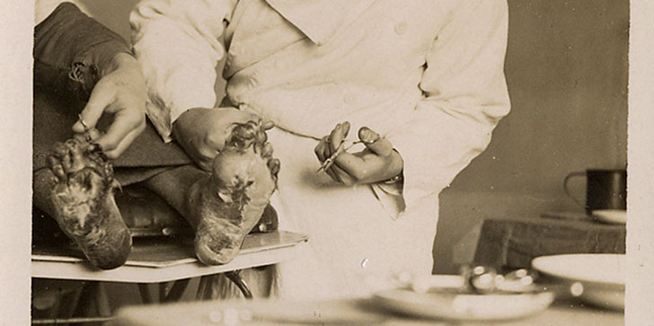 Un metge curant els peus congelats d’un refugiat espanyol, el gener de 1939.